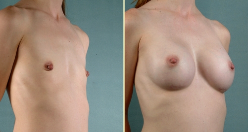 breast-augmentation-02b.jpg