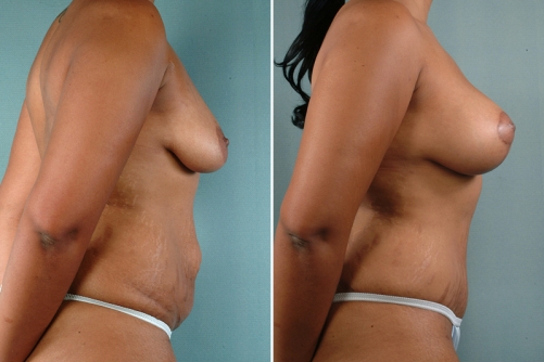 Breast Enhancement Denver