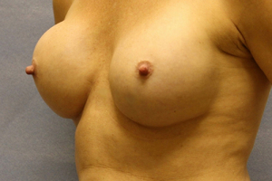 Breast-Aug-Revision-2-quarter_01