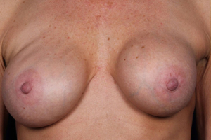 Breast-Aug-Revision-4-front_01