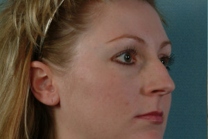 Rhinoplasty-3-quarter_01