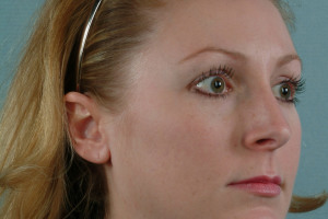 Rhinoplasty-3-quarter_02