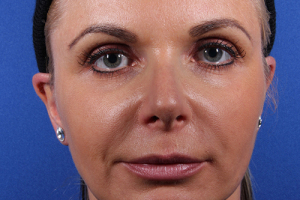 Rhinoplasty-8-front_02