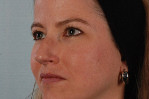 Rhinoplasty-9-quarter_01
