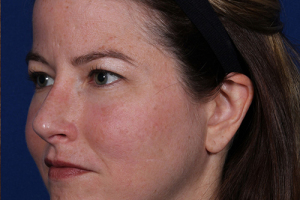 Rhinoplasty-9-quarter_02