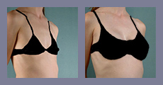 cta-gallery-breat-enhancement