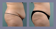 cta-gallery-tummy-tuck