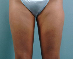 Liposuction in Denver, Highlands Ranch and Littleton