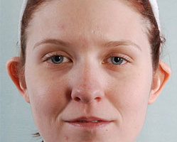 Otoplasty in Littleton, Highlands Ranch and Denver