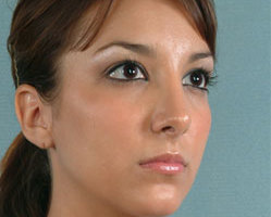 Rhinoplasty in Littleton, Highlands Ranch and Denver