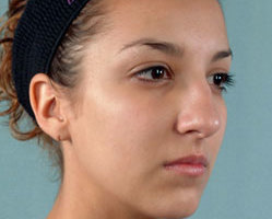 Rhinoplasty in Littleton, Highlands Ranch and Denver