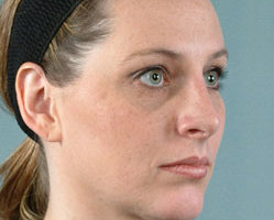 Rhinoplasty in Littleton, Highlands Ranch and Denver