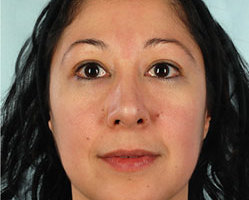 Rhinoplasty in Littleton, Highlands Ranch and Denver