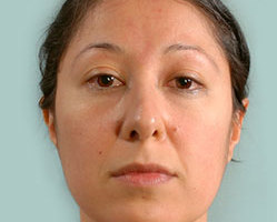 Rhinoplasty in Littleton, Highlands Ranch and Denver