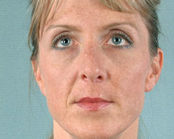 Rhinoplasty in Littleton, Highlands Ranch and Denver