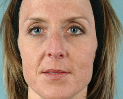 Rhinoplasty in Littleton, Highlands Ranch and Denver