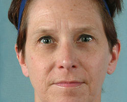 Rhinoplasty in Littleton, Highlands Ranch and Denver