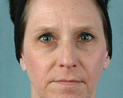Rhinoplasty in Littleton, Highlands Ranch and Denver