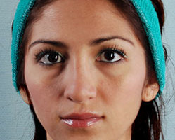 Rhinoplasty in Littleton, Highlands Ranch and Denver Septoplasty